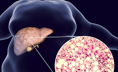 8 cách tự nhiên ngăn ngừa gan nhiễm mỡ