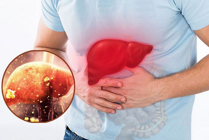  6 TRIỆU CHỨNG TĂNG MEN GAN THƯỜNG GẶP