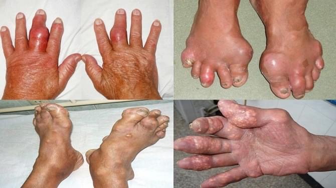 Hạt Tophi - Hậu quả tiềm ẩn của bệnh Gout