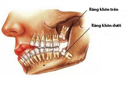 Nhổ răng số 8 có thể gặp những biến chứng gì???